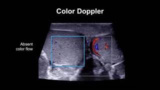 Diagnosing testicular torsion [upl. by Ecinev]