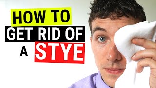 How to Get Rid of a Stye FAST  Chalazion VS Stye Treatment [upl. by Mauralia]