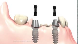 3 unit Bridge on implant abutments [upl. by Siclari]