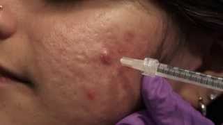 Watch amp Learn Intralesional injections [upl. by Nimajeb]