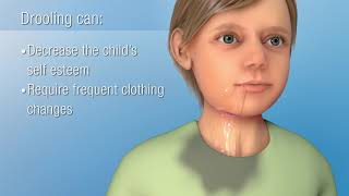 Sialorrhea Excessive Drooling  Decreasing Saliva Production [upl. by Handbook]