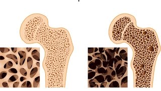 Osteoporosis [upl. by Goodard]