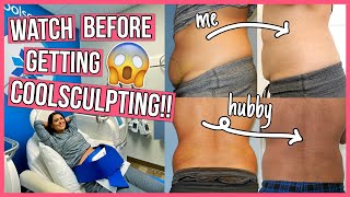 SHOCKING Coolsculpting Before amp After 6 Things You NEED to Know [upl. by Dazhehs511]